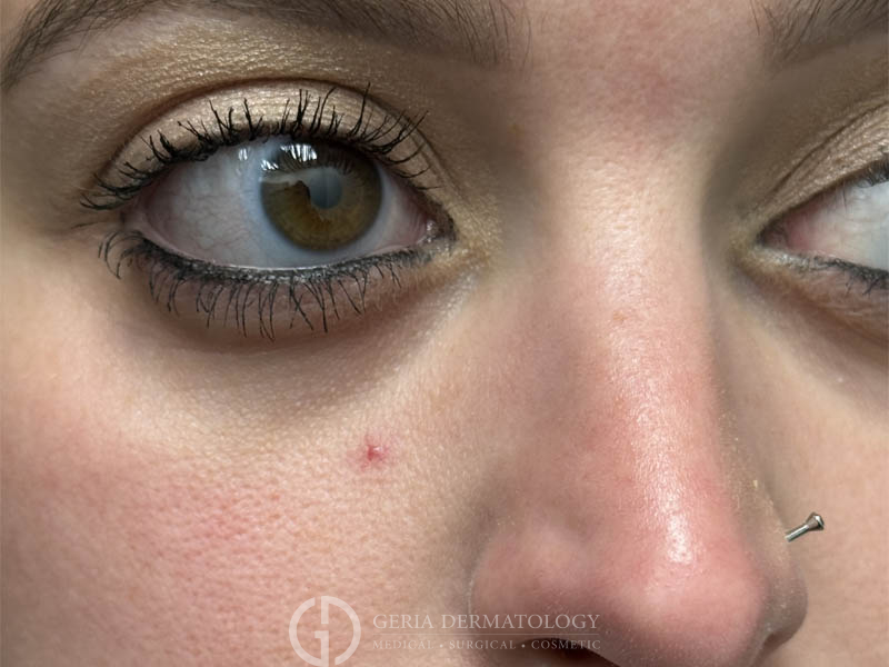 Before Image: Patient Case #48098 - right-front-oblique