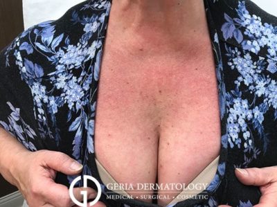 After Image: Patient Case #5110 - front