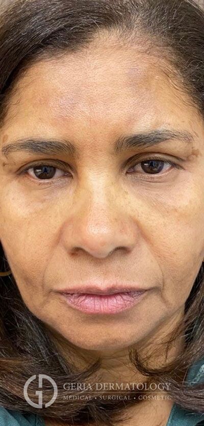 After Image: Patient Case #3894 - front