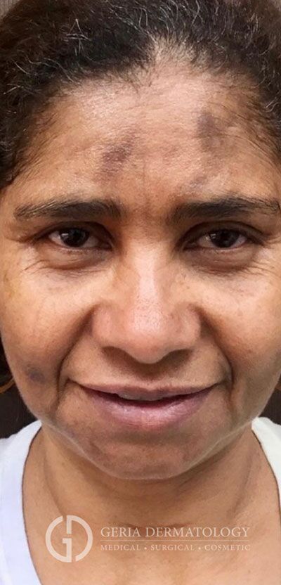 Before Image: Patient Case #3894 - front