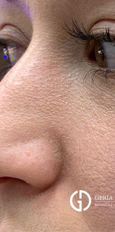 Before Image: Patient Case #258 - left-front-oblique