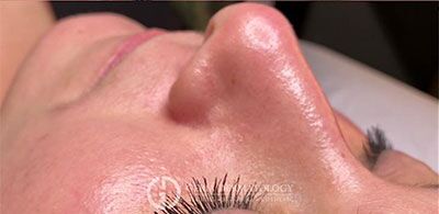 After Image: Patient Case #3912 - left-front-oblique