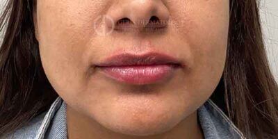 After Image: Patient Case #15917 - front