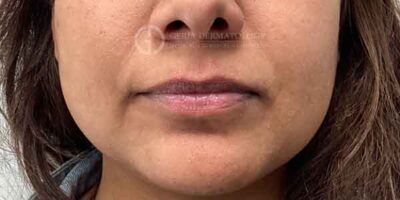 Before Image: Patient Case #15917 - front