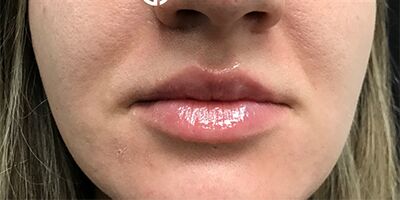 After Image: Patient Case #1709 - front