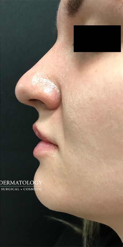 After Image: Patient Case #1709 - left-side