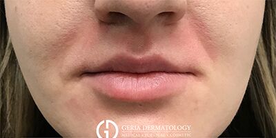 Before Image: Patient Case #1709 - front