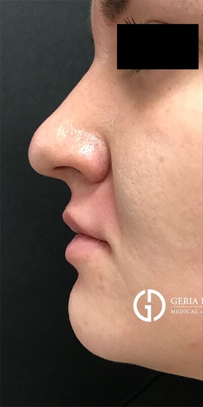 Before Image: Patient Case #1709 - left-side