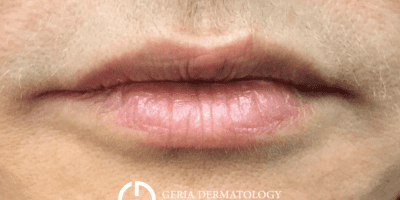 Before Image: Patient Case #2935 - front