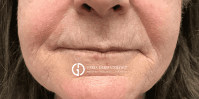 Before Image: Patient Case #2936 - front