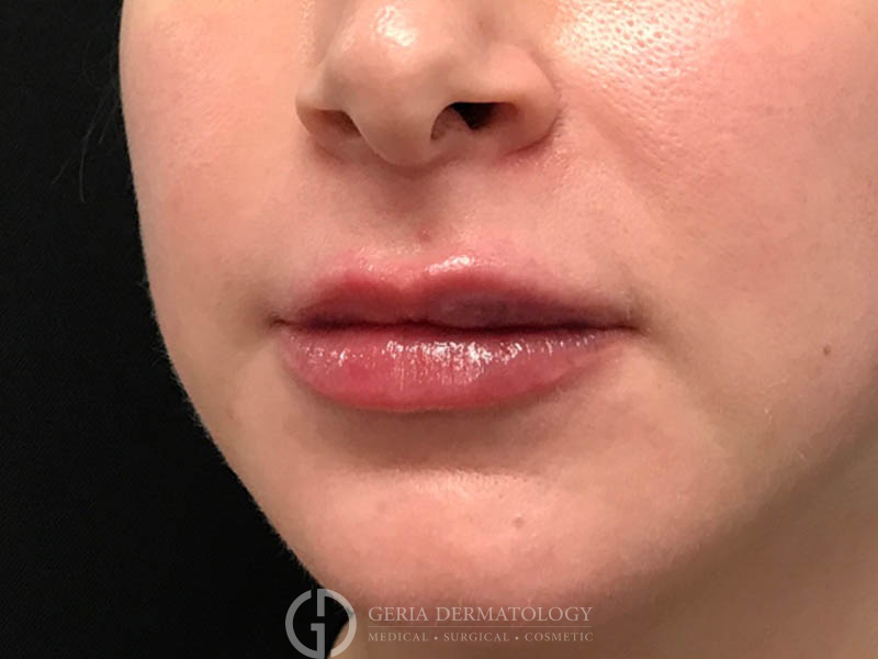 After Image: Patient Case #48074 - left-front-oblique