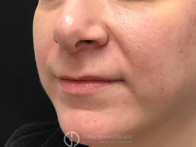 Before Image: Patient Case #48074 - left-front-oblique