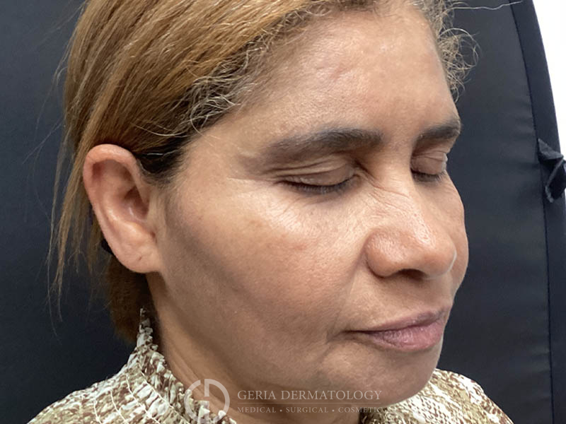 After Image: Patient Case #48080 - right-front-oblique