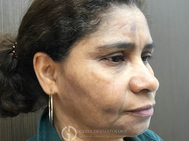 Before Image: Patient Case #48080 - right-front-oblique