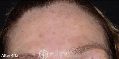 After Image: Patient Case #5925 - front