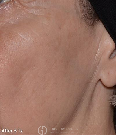 After Image: Patient Case #5928 - left-front-oblique