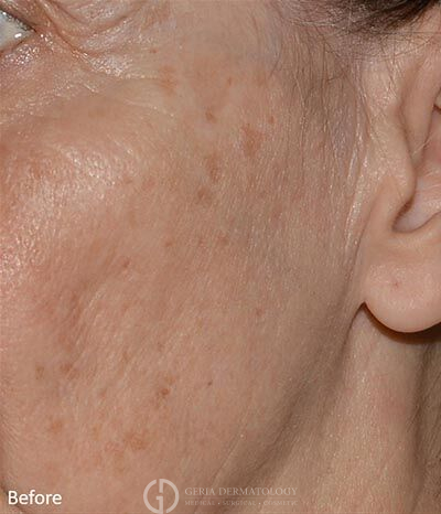 Before Image: Patient Case #5928 - left-front-oblique