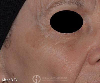After Image: Patient Case #5931 - right-front-oblique