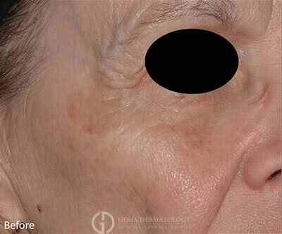 Before Image: Patient Case #5931 - right-front-oblique