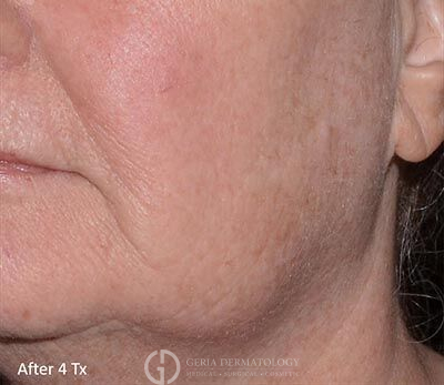 After Image: Patient Case #5934 - left-front-oblique