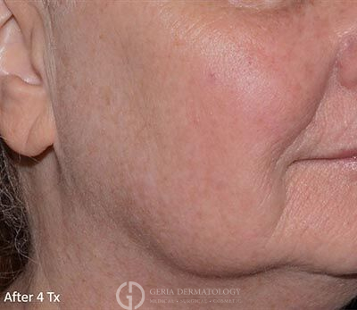 After Image: Patient Case #5934 - right-front-oblique