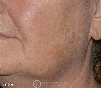 Before Image: Patient Case #5934 - left-front-oblique