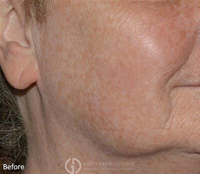 Before Image: Patient Case #5934 - right-front-oblique