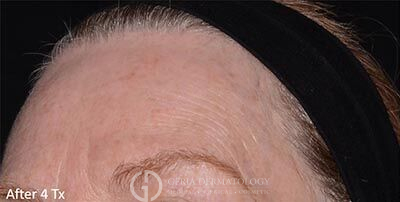 After Image: Patient Case #5939 - left-front-oblique