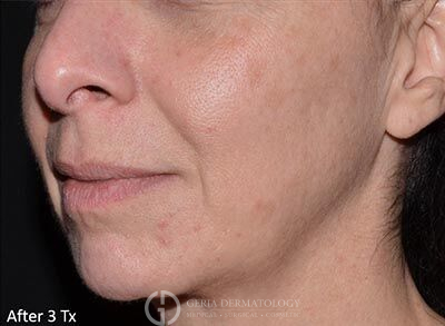 After Image: Patient Case #5942 - left-front-oblique