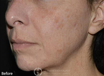 Before Image: Patient Case #5942 - left-front-oblique