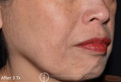 After Image: Patient Case #5947 - right-front-oblique