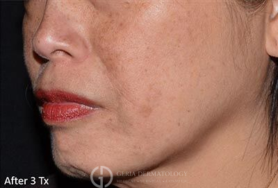 After Image: Patient Case #5947 - left-front-oblique