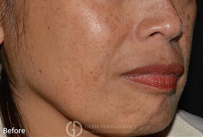 Before Image: Patient Case #5947 - right-front-oblique