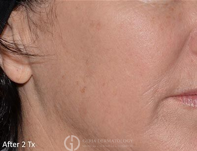 After Image: Patient Case #5952 - right-front-oblique