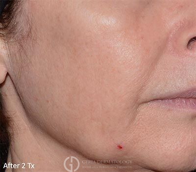 After Image: Patient Case #5958 - right-front-oblique