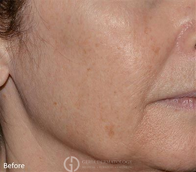 Before Image: Patient Case #5958 - right-front-oblique