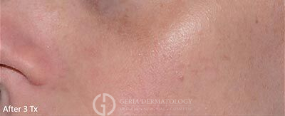 After Image: Patient Case #5961 - left-front-oblique