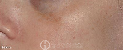 Before Image: Patient Case #5961 - left-front-oblique