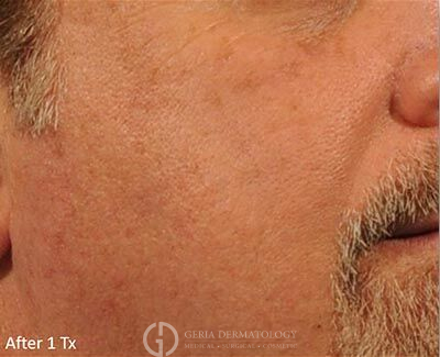 After Image: Patient Case #5964 - right-front-oblique