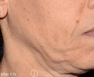 After Image: Patient Case #5967 - right-front-oblique