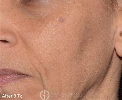 After Image: Patient Case #5967 - left-front-oblique