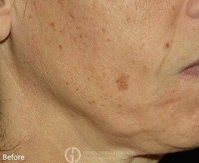 Before Image: Patient Case #5967 - right-front-oblique