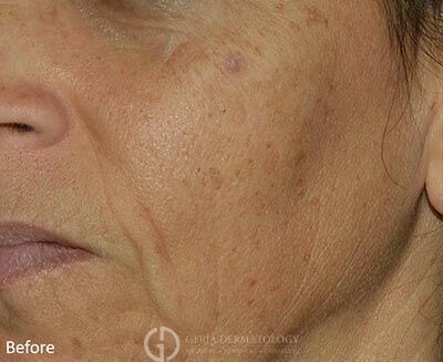 Before Image: Patient Case #5967 - left-front-oblique