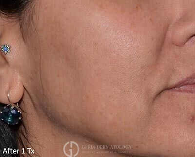 After Image: Patient Case #5972 - right-front-oblique