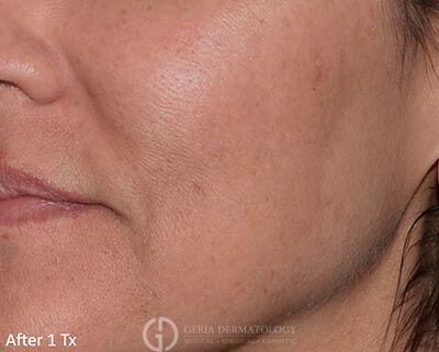 After Image: Patient Case #5972 - left-front-oblique