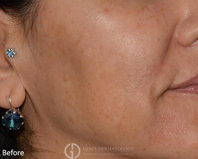 Before Image: Patient Case #5972 - right-front-oblique