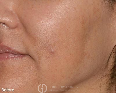 Before Image: Patient Case #5972 - left-front-oblique