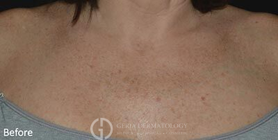 Before Image: Patient Case #5978 - front