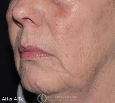 After Image: Patient Case #6901 - left-front-oblique