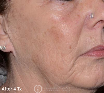 After Image: Patient Case #6901 - right-front-oblique